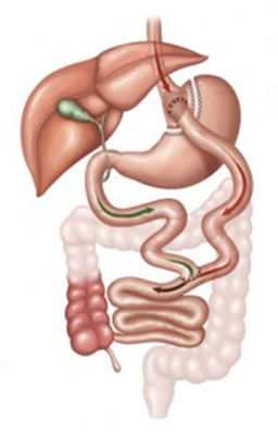 Cirurgia Bypass Gástrico em Curitiba, Cirurgia de Capella em Curitiba