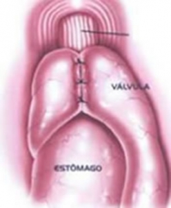 Cirurgia Refluxo Curitiba