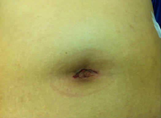Cirurgia Single Port em Curitiba