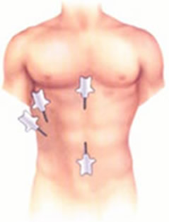 Cirurgia de vesícula